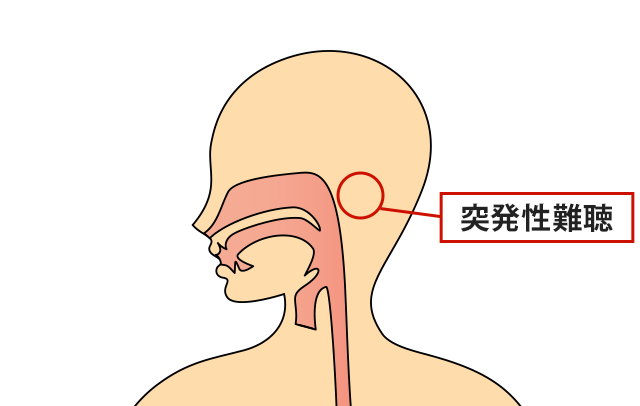 症状の該当箇所のイラスト