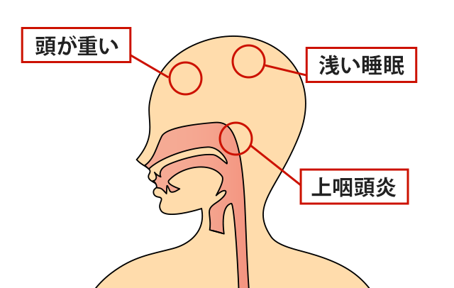 症状の該当箇所のイラスト