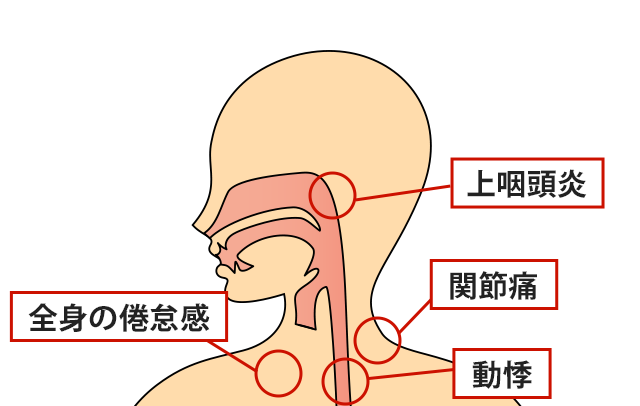 症状の該当箇所のイラスト